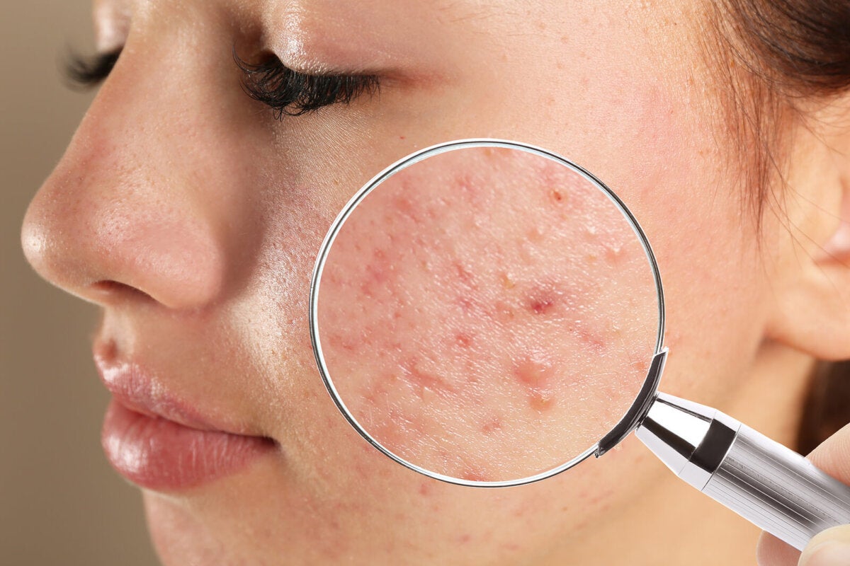 📌 ¿Cómo empieza realmente el camino para curar el acné? - DERMATOP